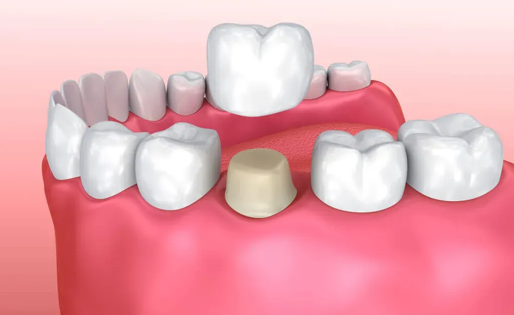 qué hacer cuando una corona dental se cae