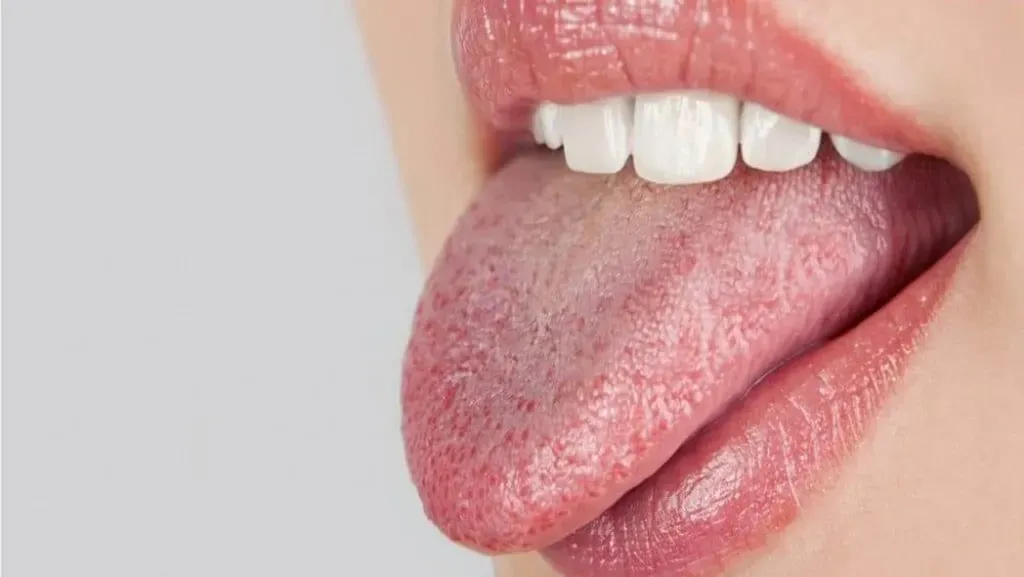 dry mouth: causes, remedies, and treatments