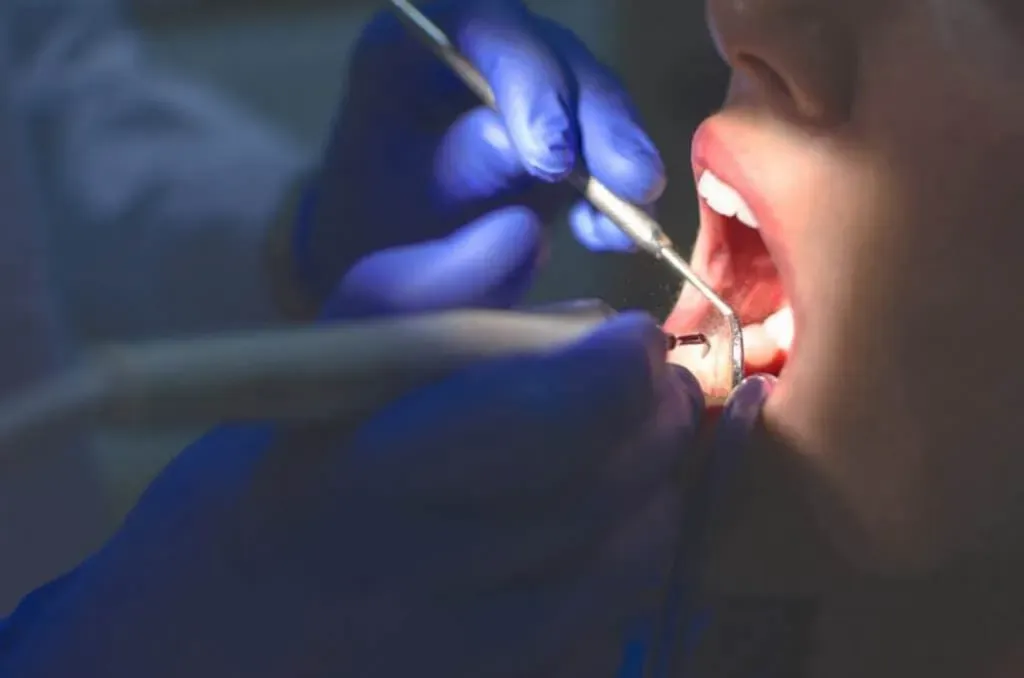 ¿por qué hay que hacer una limpieza profunda de dientes?