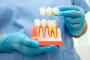dental bridge role in smile