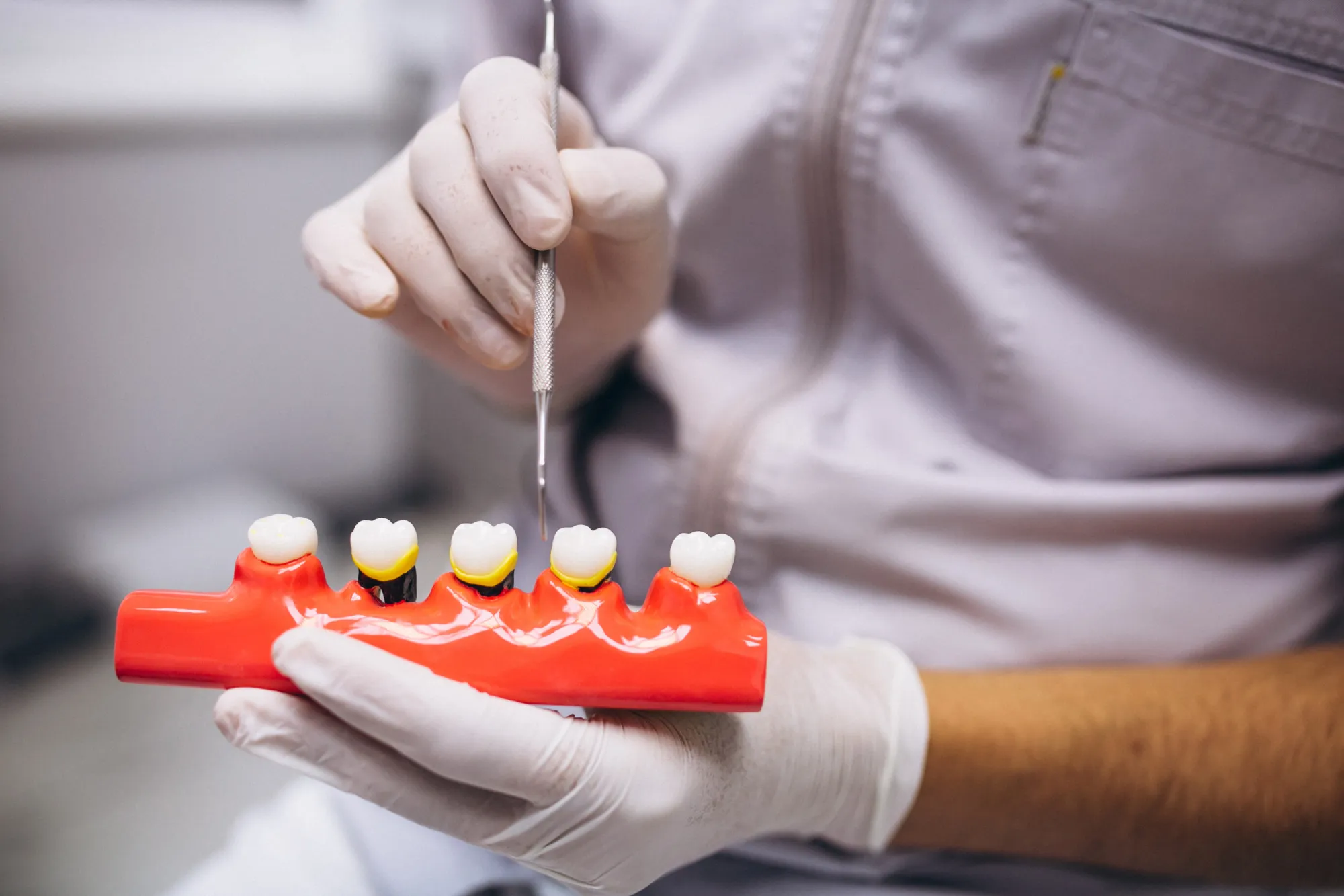 The Benefits of Dental Crowns for a Stronger Smile
